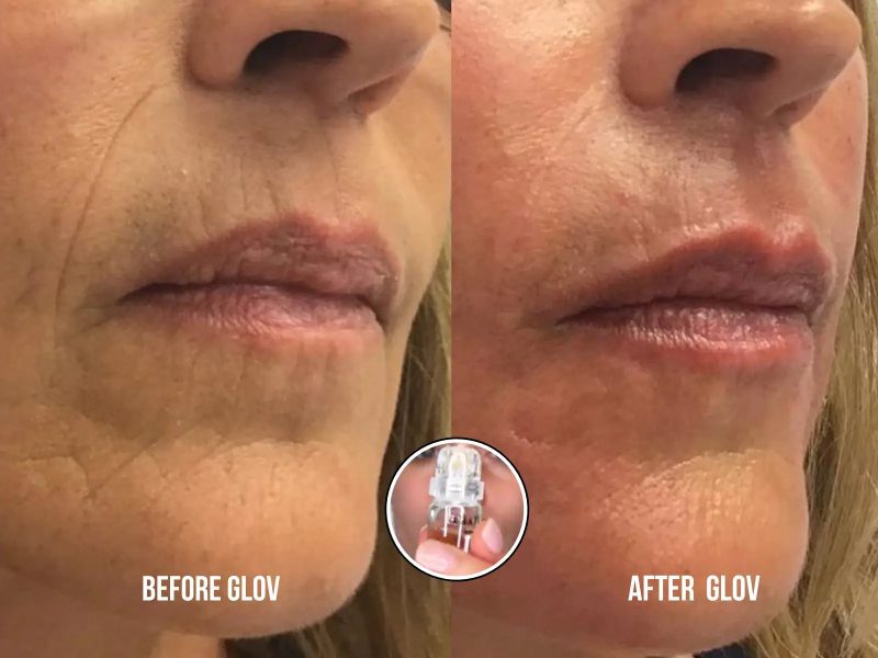 Anti Aging treatment Glov Beauty 490291076