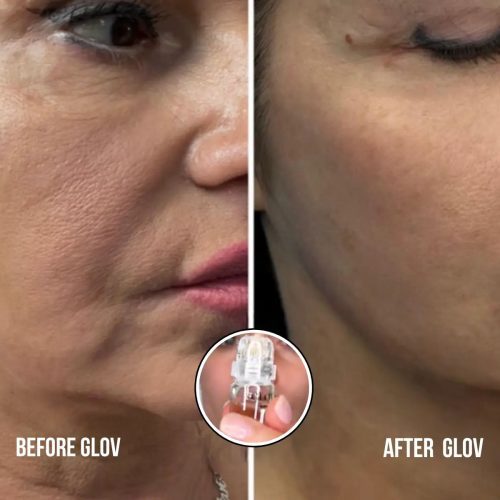 Anti Aging treatment Glov Beauty 490291136