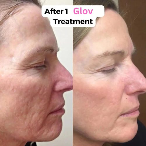 Glov Micro Infusion System Glov Beauty 59794434